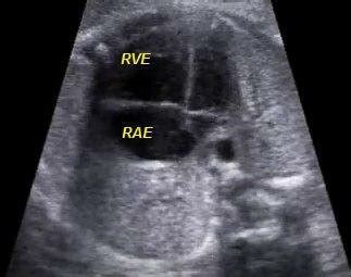 Suprasternal Notch View In Transthoracic Echocardiography Showed