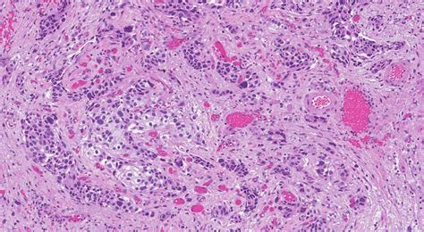 Invasive Urothelial Carcinoma Ottawa Atlas Of Pathology