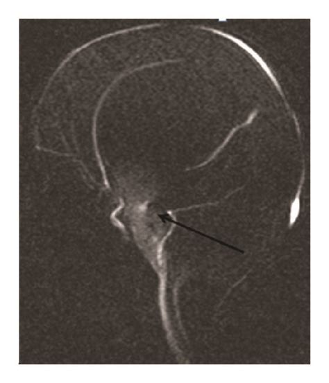 (a, b, c) MRI CSF flow study: arrow shows CSF flow at the floor of... | Download Scientific Diagram