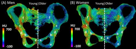 Three Dimensional Models Showing The Distribution Of Hounsfield Unit Download Scientific