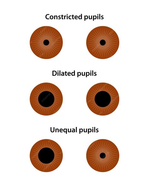 Premium Vector Human Eye Constricted Dilated And Unequal Pupils