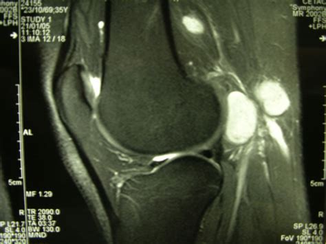 Sagittal MRI of the left popliteal fossa showing two involved nodes ...