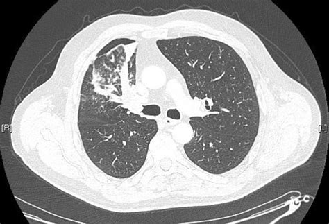 Adenoid Cystic Carcinoma And Chronic Lymphocytic Leukaemia Synchronous Presentations In The