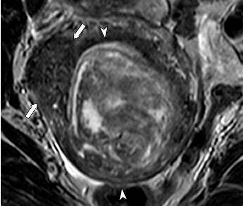 Adenomyosis A Sonographic Diagnosis Radiographics