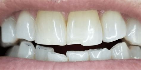 View Patient Results Porcelain Veneers And Dental Bonding Los Gatos