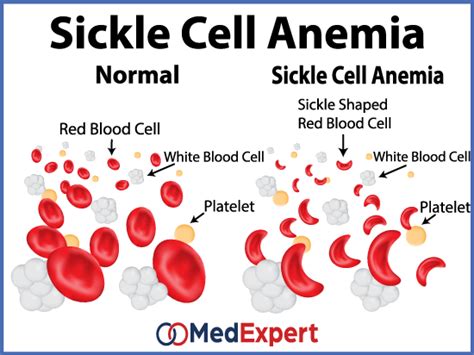 Sickle Cell Anaemia Med Expert Singapore