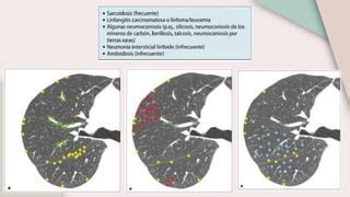 Patrones Radiol Gicos Enfermedad Pulmonar Nodular Pptx Descarga Gratuita