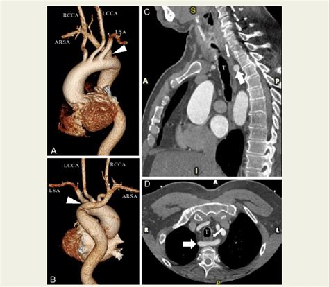 Msct D Volume Rendering Reconstructions A Anterior And B Posterior