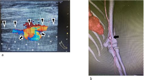 a. Ultrasound image. Broad entry pseudoaneurysm (indicated by an arrow ...