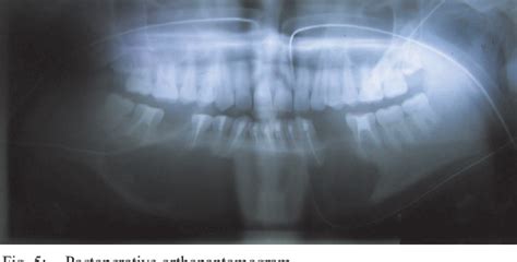 Figure 5 From Conservative Management Of Keratocystic Odontogenic