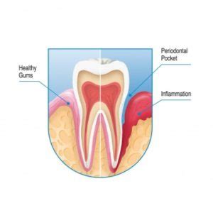 Bleeding gums - Prevention & Deep cleaning treatment in Aurora, IL ...