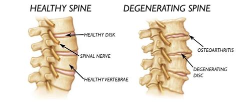 Spinal Disc Degeneration - Causes and Treatments - 4Nids