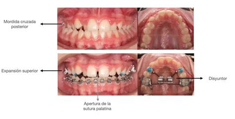 Expansi N Maxilar En El Paciente De Ortodoncia Luis Gonz Lez Ortodoncia