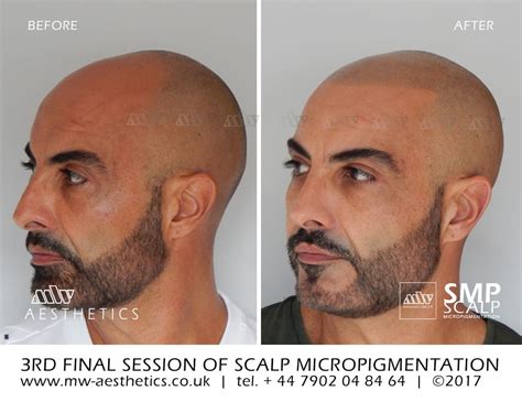 Scalp Micropigmentation | Hair Tattoo | London | MW Aesthetics