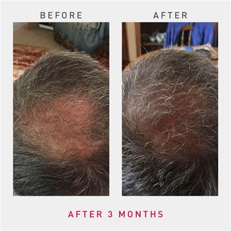 Irestore Laser Hair Growth System Professional Revolt