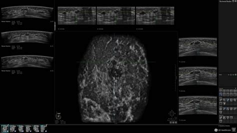 Clinical Evidence Invenia Abus Abus Breast Imaging Ultrasound Products Ge Healthcare