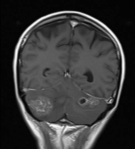 Mri T Post Contrast Gadolinium Sequence Physics And Image Appearance