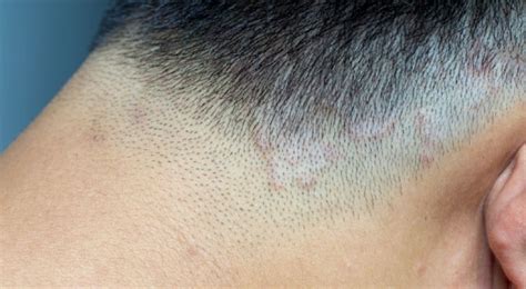 Hairloss And Scalp Disease Sinclair Dermatology