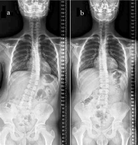 Spine Scoliosis X Ray