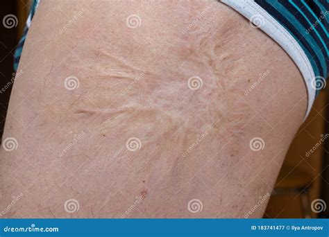 Scar on the Hip. Huge Scar after Surgery Stock Image - Image of ...