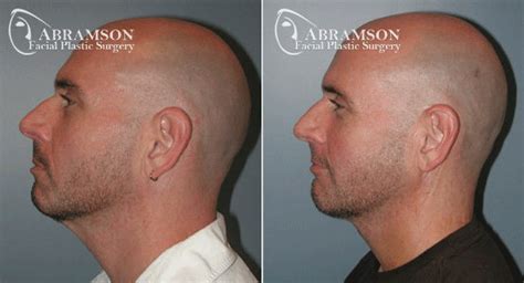 Mini and Full Facelift Before and After Photos | Abramson Facial Plastic Surgery