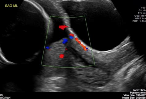 Placenta Previa Ultrasound