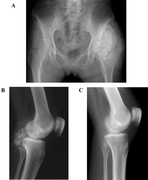 X Ray Films Of Tumoral Calcinosis Tumoral Calcinosis Around The Left