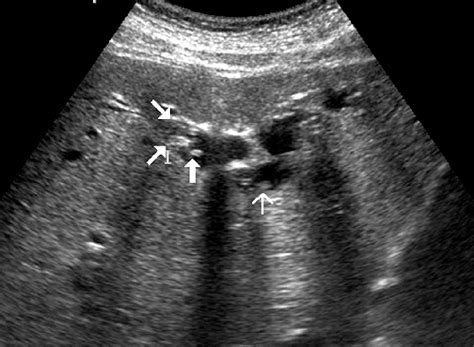 Three Weeks After The First Treatment A Transverse Sonogram Shows Download Scientific Diagram