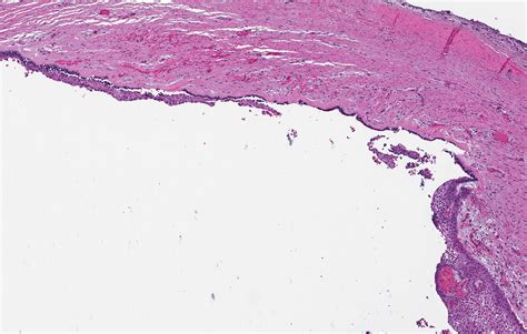 Ameloblastoma Histology