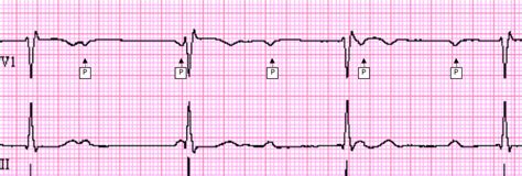 Complete Heart Block - ECG Made Simple