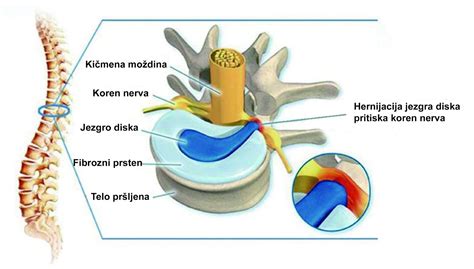 Kako Lije Iti Diskus Herniju Prirodnim Putem