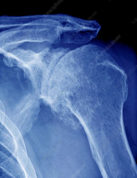 Osteoarthritis of the shoulder, X-ray - Stock Image - C037/2764 ...