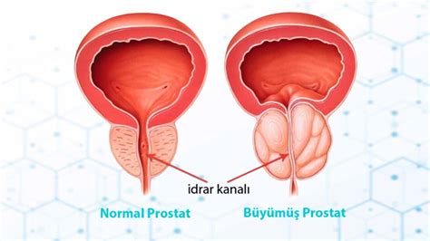 Yi Huylu Prostat B Y Mesi Benign Prostat Hiperplazisi Nedir