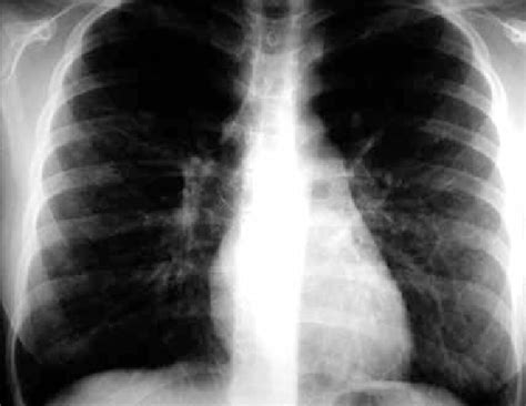 Radiografía de tórax que demuestra patrón bronquítico crónico con