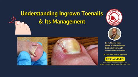 Understanding Ingrown Toenails And Its Management Boston Aesthetics