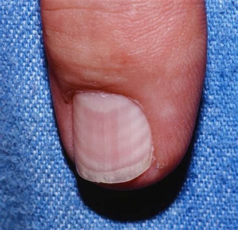 What Vitamin Deficiency Causes Vertical Lines In Nails Design Talk