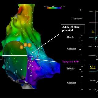 Lat Mapping From The Sinus Node To Kochs Triangle During Sinus Rhythm