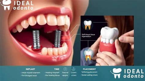Quantos Dias De Repouso Após Implante Dentário - Guia de recuperação de implante dentário: tudo o que você precisa saber