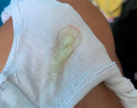 Tamp O Mucoso No In Cio Da Gravidez Maternidade Hospital Octaviano