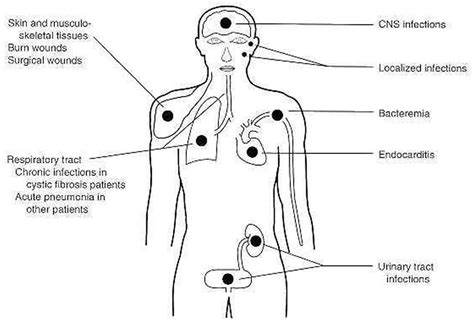 Pseudomonas & pseudomonas aeruginosa infections and treatment