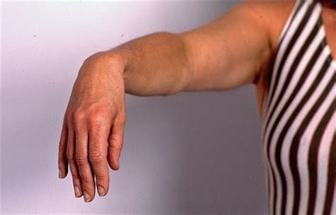 Wrist drop (Saturday Night Palsy): | Electrotherapy for MSP