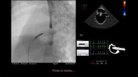 Atrial Septal Defect And Patent Foramen Ovale Occlusion Asd Pfo