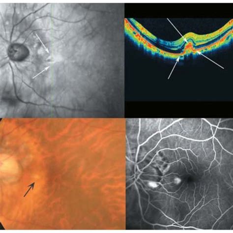 SLO-OCT image of a myopic posterior pole with chorioretinal atrophy ...