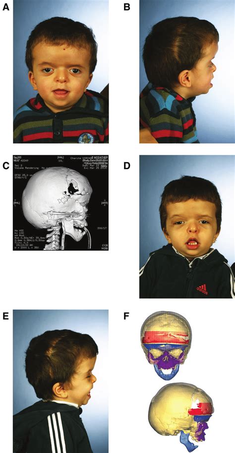 3 Year Old Boy Affected By Craniofacial Dysostosis M Apert With