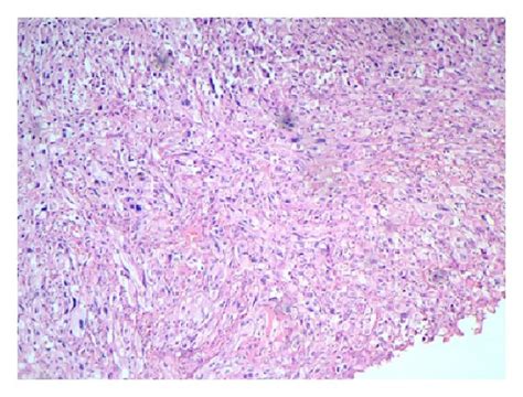 A Photomicrograph Of Amelanotic Melanoma Shows Diffuse Proliferation