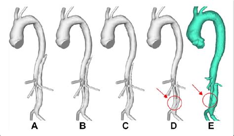 Evolution Of False Lumen Fl Surface In P1 Following Thrombus Growth