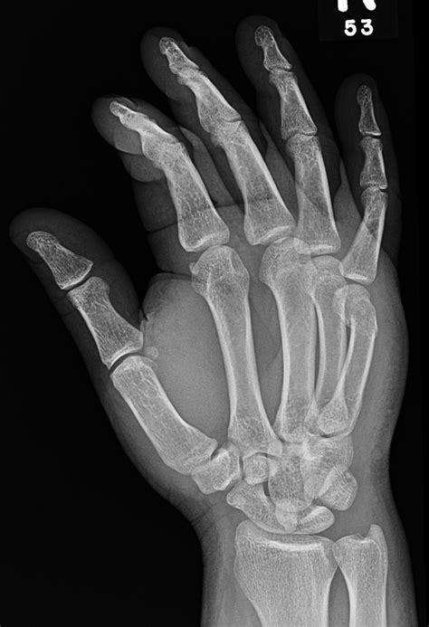 Boxer's fracture - wikidoc