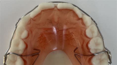 Retainers And The Importance Of Orthodontic Retention