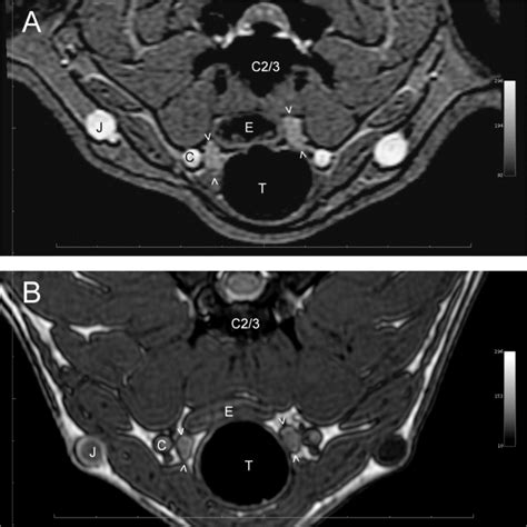 Transverse Ge A And 3d T2 Ge B Images Showing Both Thyroid Lobes Download Scientific