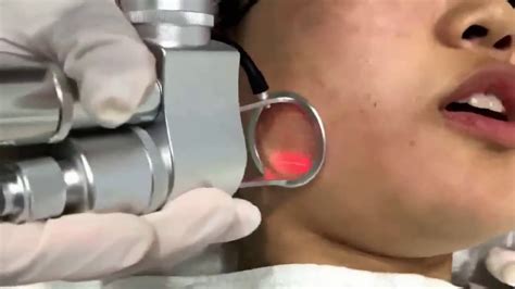 Co2 Fractional Laser Beauty Machine Youtube